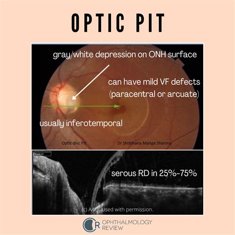 Optic Pit — Ophthalmology Review