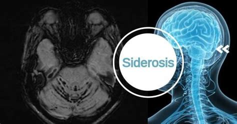 Superficial Siderosis : Importance of Susceptibility MRI Imaging - Blogs