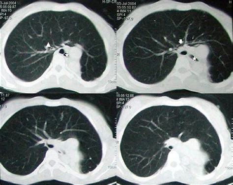 Figure 3 from Unilateral pulmonary hypoplasia | Semantic Scholar