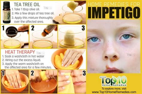 Impetigo: Home Remedies, Prevention, and When to See a Doctor | Top 10 Home Remedies | Impetigo ...