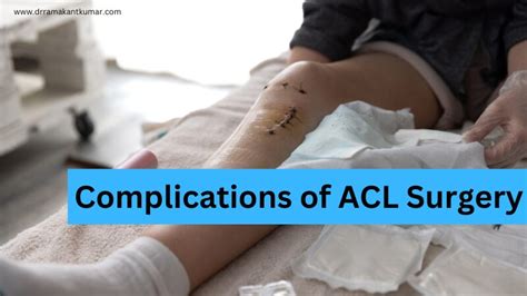 Common ACL Surgery Complications - 6 After Surgery Risks