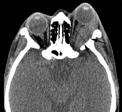 CT scan revealed a larger mass out of the left eye muscular cone space ...