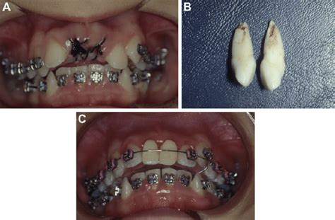 Aspect (A) after tooth extraction, (B) extracted teeth, (C) aesthetic ...