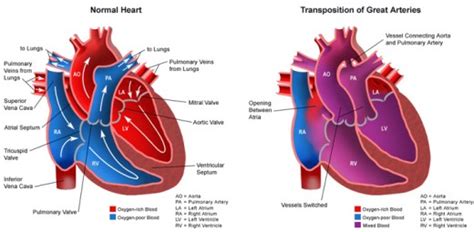 Transposition of the Great Arteries | Dangerous Drugs & Medical Devices