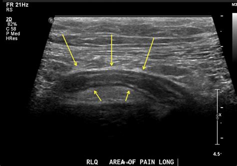 Appendicitis - Stepwards