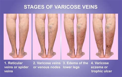 Varicose Veins | Orthopedics and Pain Medicine Physician located in ...