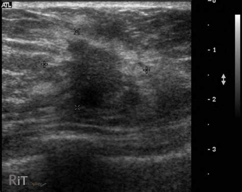 RiT radiology: Ultrasound Features of Malignant Breast Mass