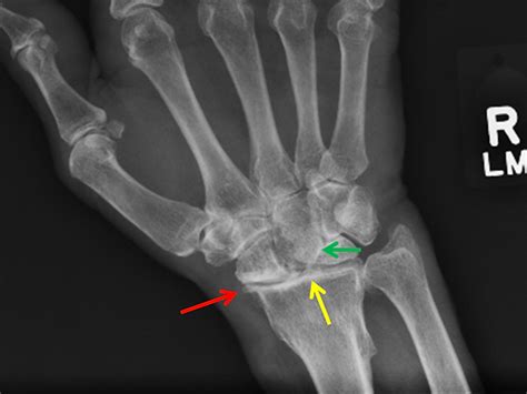 Scapholunate Advanced Collapse (SLAC Wrist)