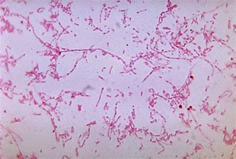 Anaerobic Infections: Is Fusobacterium associated with colon cancer?