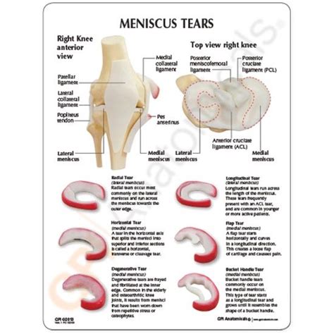 Lateral Meniscus Tear Posterior Horn