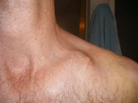 Causes of Lump Under Collarbone - IYTmed.com