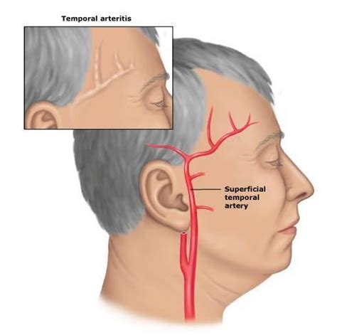 What is a sign of bad circulation in the face? | Temporal arteritis, Polymyalgia rheumatica ...