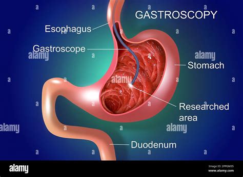 Digestive endoscopy or gastroscopy. Performing a gastroscopy procedure ...