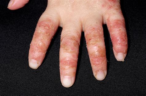 Infected Eczema Photograph by Dr P. Marazzi/science Photo Library