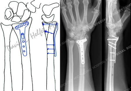 Wrist Fractures - Orthopedic Trauma Service