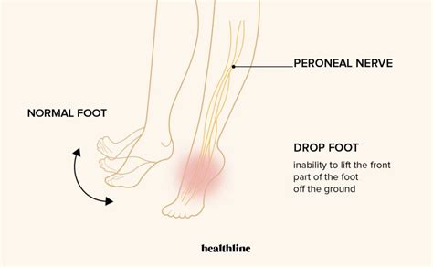 Foot Drop: What It Is, Causes, Symptoms Treatment | atelier-yuwa.ciao.jp