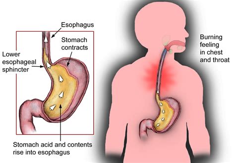 Why You Have Reflux, Bloating, Gas and Burping and What To Do - Josh Gitalis