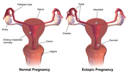 Ectopic pregnancy