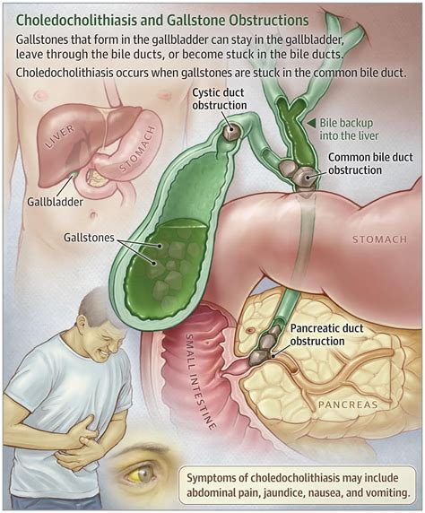 Medical Biotechnology on Instagram: “Choledocholithiasis ...