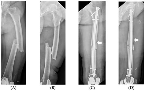 Intramedullary Nailing Femur Recovery - Nail Ftempo