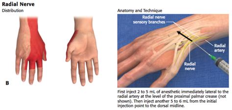 EM Didactic: Wrist Block (Landmark Technique)