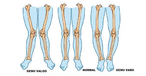 Genu varo y genu valgo | Familia y Salud