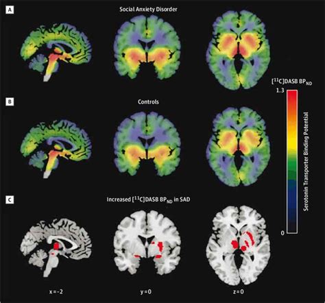 Increased Serotonin Transporter Availability in Social Anxiety Disorder ...