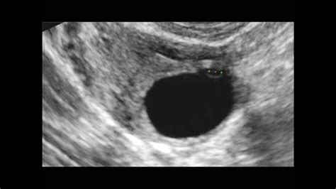 Fertility ultrasound Normal Cumulus oophorus