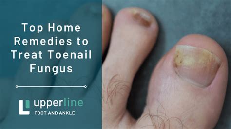 Top Home Remedies to Treat Toenail Fungus