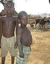 File:Niger childhood malnutrition 16oct06.jpg - Wikimedia Commons