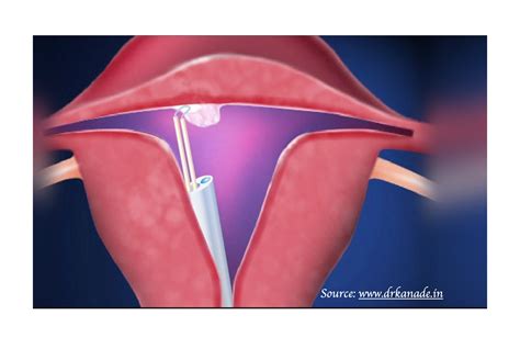 Uterine Fibroid Embolisation and Other Fibroid Treatments | Sydney ...