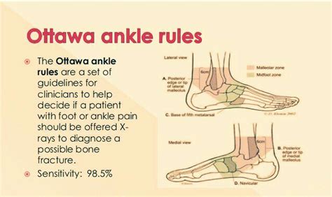 Ankle Sprain - PT Master Guide