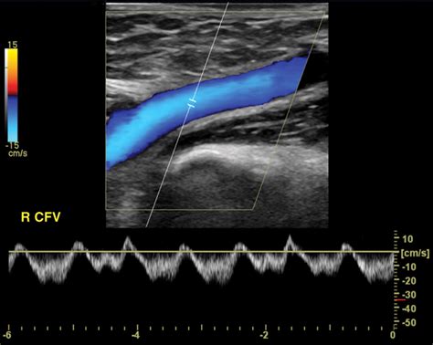 Venous Doppler Sonography Of The Extremities: A Window To, 41% OFF