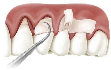 Gum Recession Treatment in Austin, TX | 8118 Dental