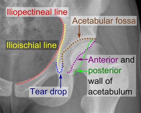 File:Iliopectineal line, ilioischial line, tear drop, acetabular fossa ...