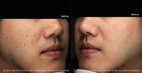 Freckles Removal Treatment by Laser - Patient’s Experience in Singapore 2022