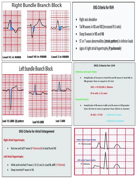 Ekg Interpretation Cheat Sheet / EKG/ECG Cheat Sheet | Nursing tips, Nursing notes, Cardiac ...