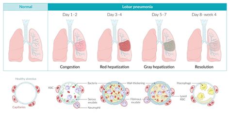 Phases Of Pneumonia