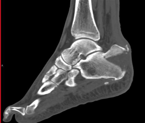 Avulsion Fracture of the Calcaneus - Musculoskeletal Case Studies - CTisus CT Scanning