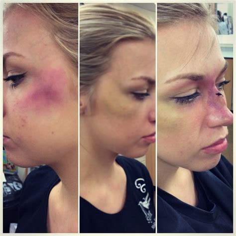 New and old bruise and a broken nose | Edi P.'s (edipantraaay) Photo ...