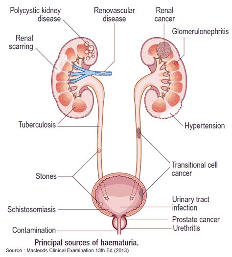 Approach to Hematuria and Proteinuria - Manual of Medicine