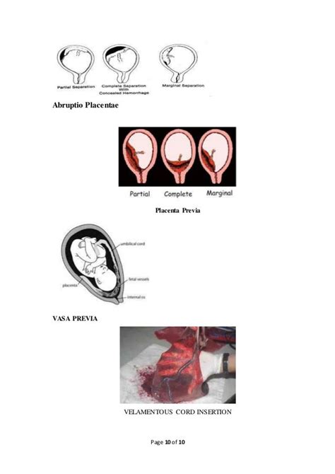 Antepartum bleeding