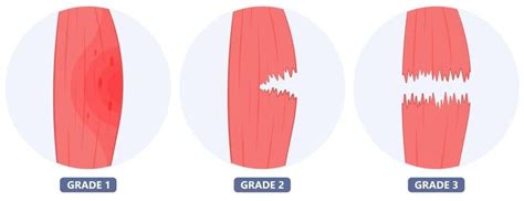 How To Prevent Hamstring Injuries & Avoid A Hamstring Strain | Kinematics