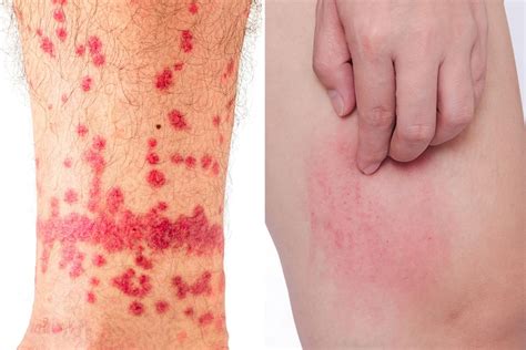 From ticks to spiders... 11 pictures of common bug bites - and how to spot their symptoms