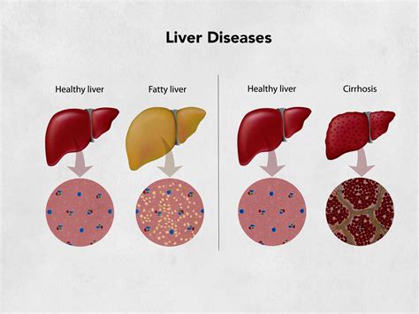 Liver Fibroscan Procedure Cape Town | Liver Disease Management