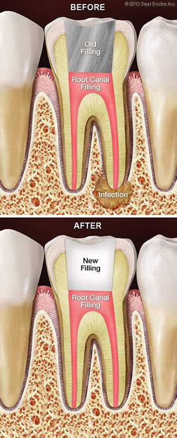 can you drive after a root canal treatment - Many Wendt