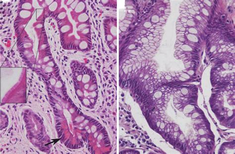 Photograph of gastric intestinal metaplasia (4). (A) Complete type with ...