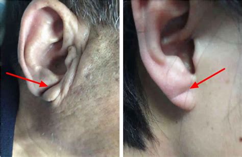 Earlobe crease, diagonal earlobe crease and heart disease