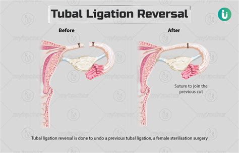 Tubal ligation reversal: Procedure, Purpose, Results, Cost, Price, Indications, Recovery