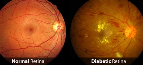 Diabetic Eye Disease Raleigh | Routine Eye Exams Clayton, NC